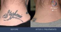 Rethink Laser Tattoo Removal image 2